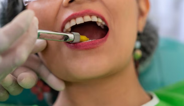 Tooth Coloured Fillings in Delhi NCR