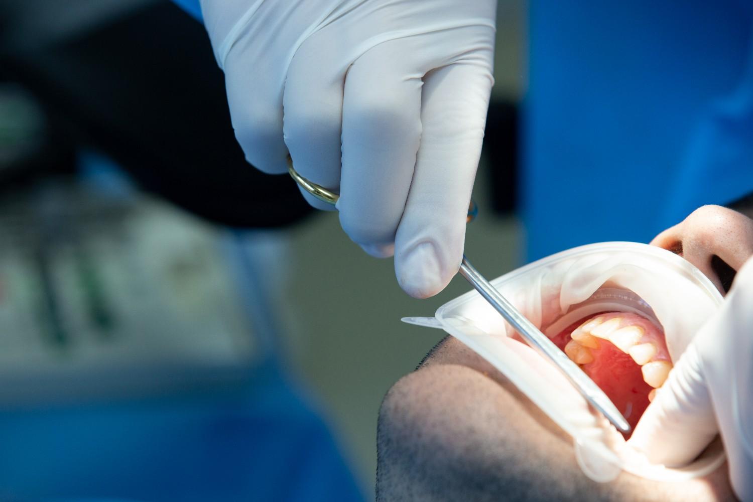 Tooth Extraction Specialist in Ghaziabad