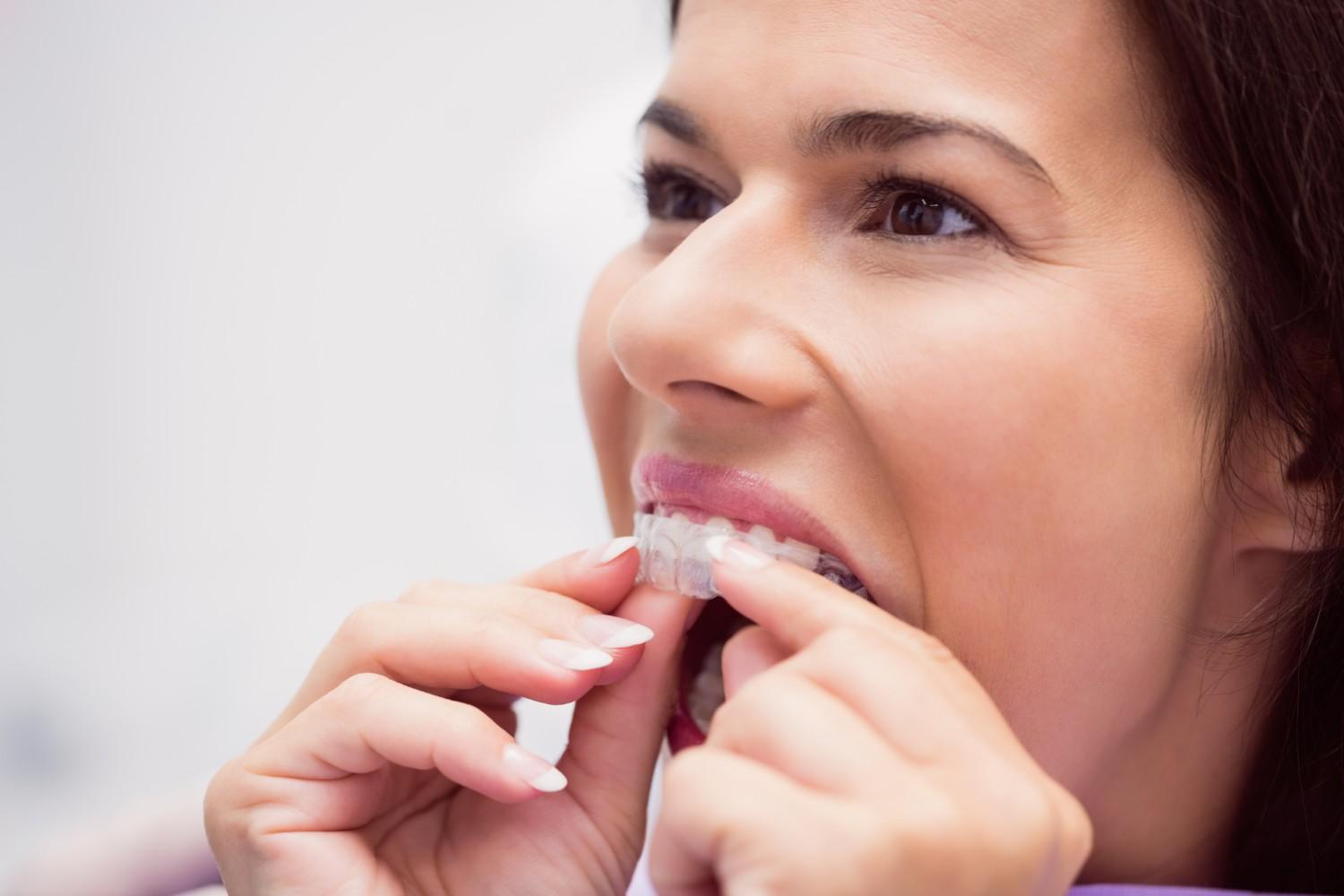 Best Invisalign Clear Aligners Clinic in Noida