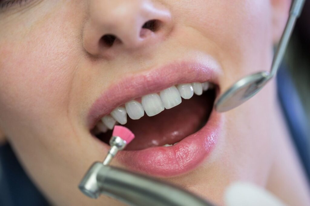 Tooth Coloured Fillings in Delhi NCR
