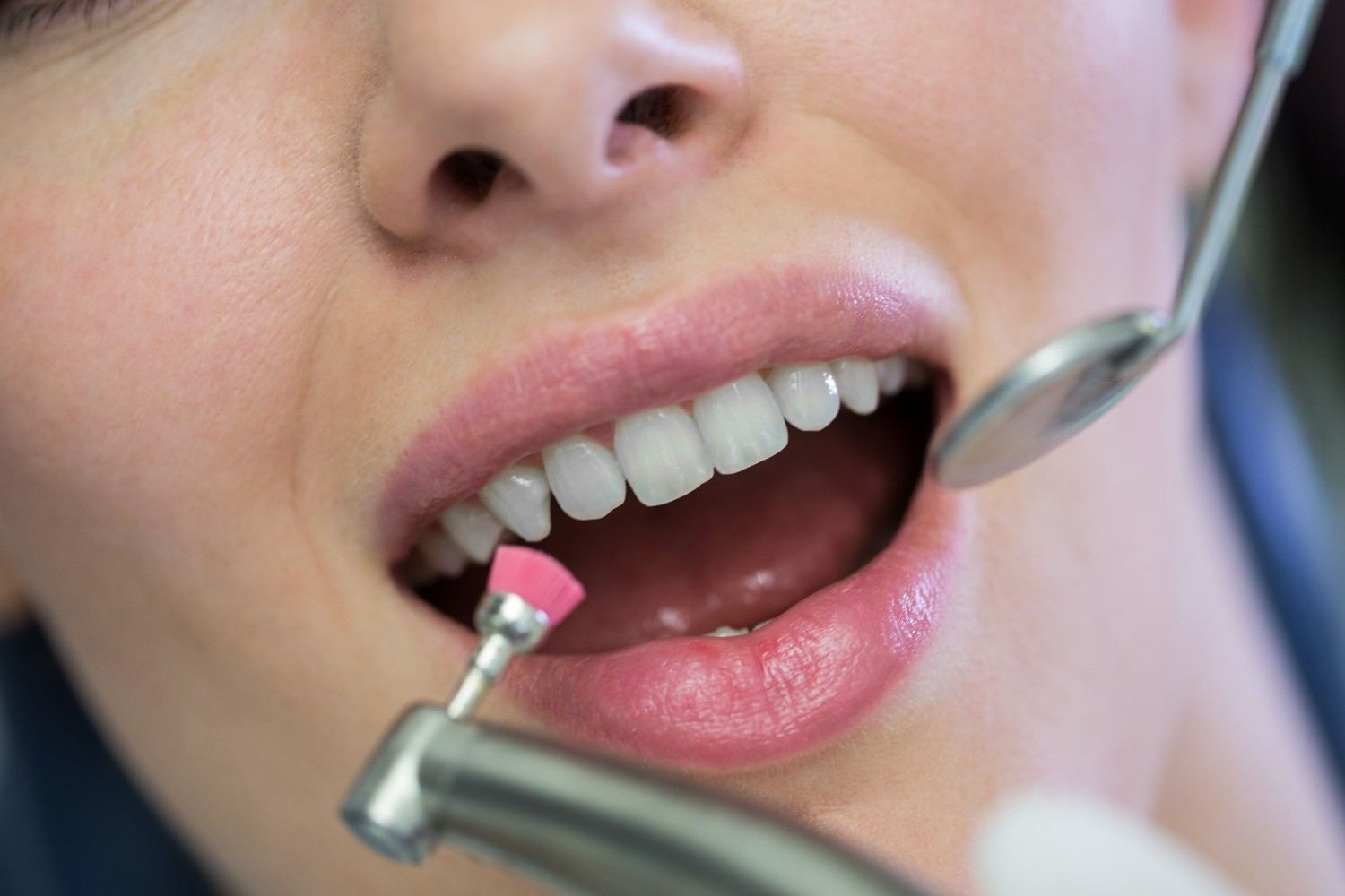 Tooth Coloured Fillings in Delhi NCR