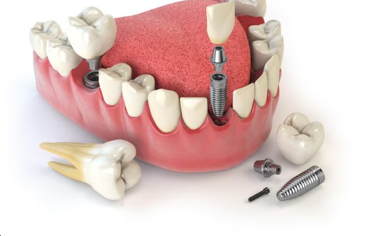 Dental Implant Clinic in Delhi NCR