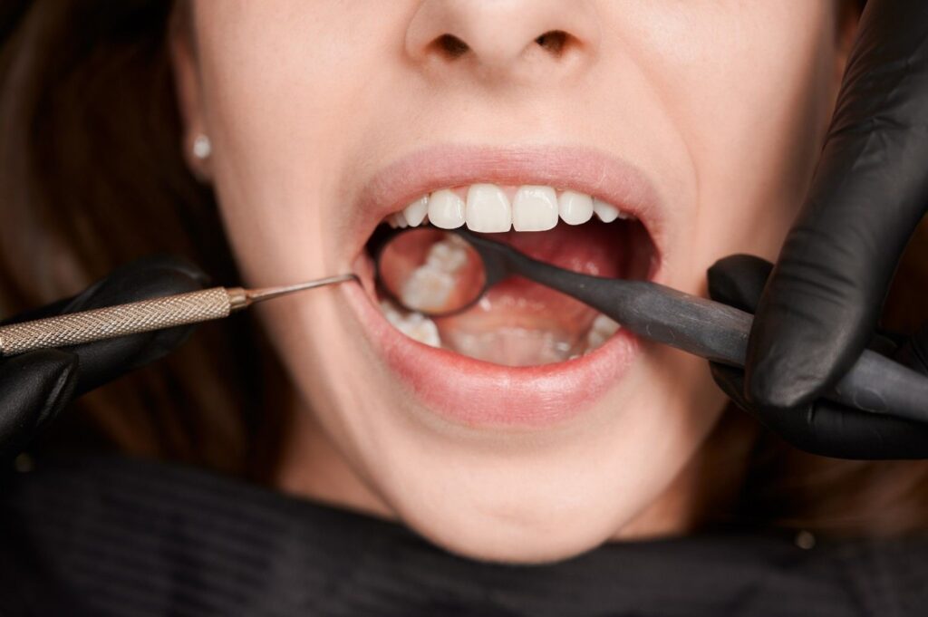 Wisdom Tooth Extraction in Delhi NCR